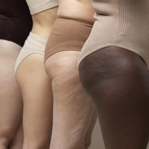 Blasting Away Cellulite with Diet and Exercise
